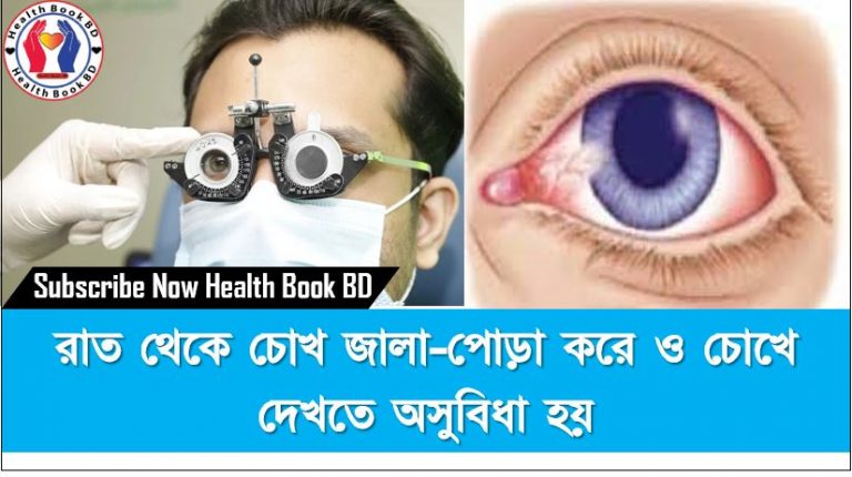 রাত থেকে চোখ জালা-পোড়া করে ও চোখে দেখতে অসুবিধা হয়,চোখ জ্বালাপোড়ায় করণীয়,চোখের জ্বালাপোড়া ও ব্যথা কমানোর ৫ উপায়,চোখ জ্বলে কেন