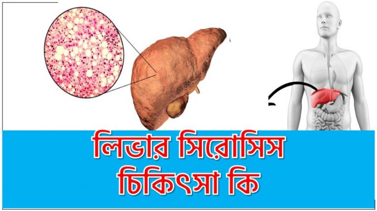 লিভার সিরোসিস প্রতিরোধে করণীয়,লিভার সিরোসিস প্রতিরোধের উপায় ,লিভার সিরোসিস প্রতিকার