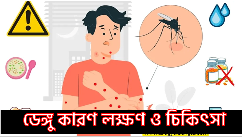 ডেঙ্গু কারণ লক্ষণ ও চিকিৎসা, ডেঙ্গু লক্ষণ ও প্রতিকার,ডেঙ্গু লক্ষণ ও প্রতিকার, ডেঙ্গু কেন হয়? লক্ষণ ও চিকিৎসা কি?, ডেঙ্গু লক্ষণ ও চিকিৎসা